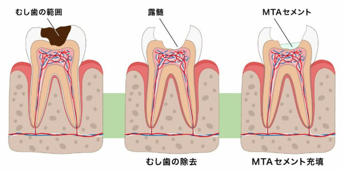 歯髄温存治療［MTAセメント］の治療イメージ
